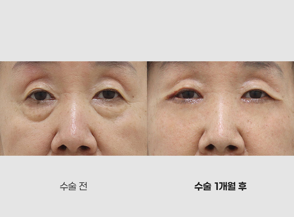 중안면거상전후사진1