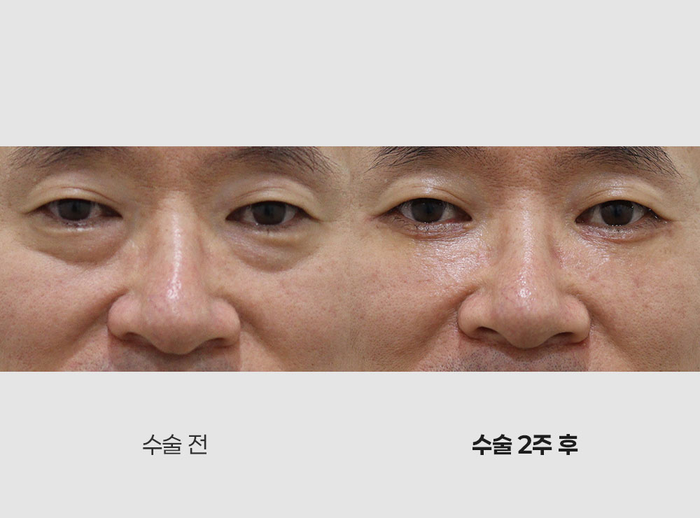 중안면거상전후사진2