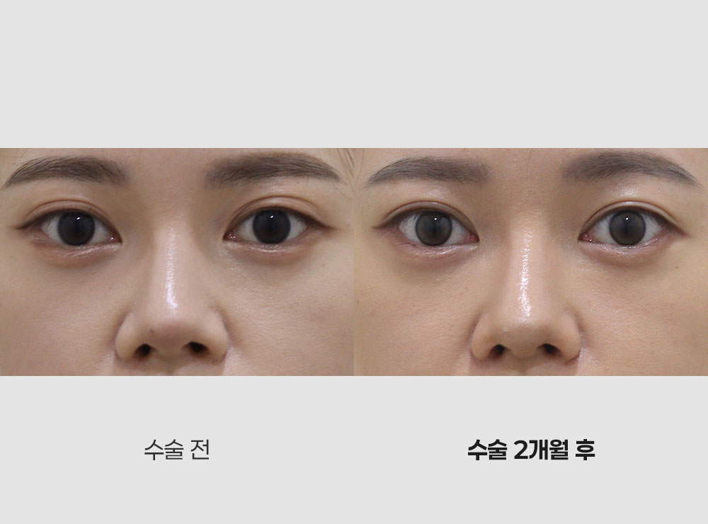 매몰쌍꺼풀수술전후사진