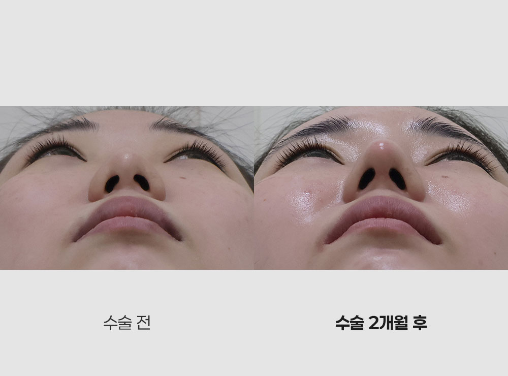 코성형전후사진