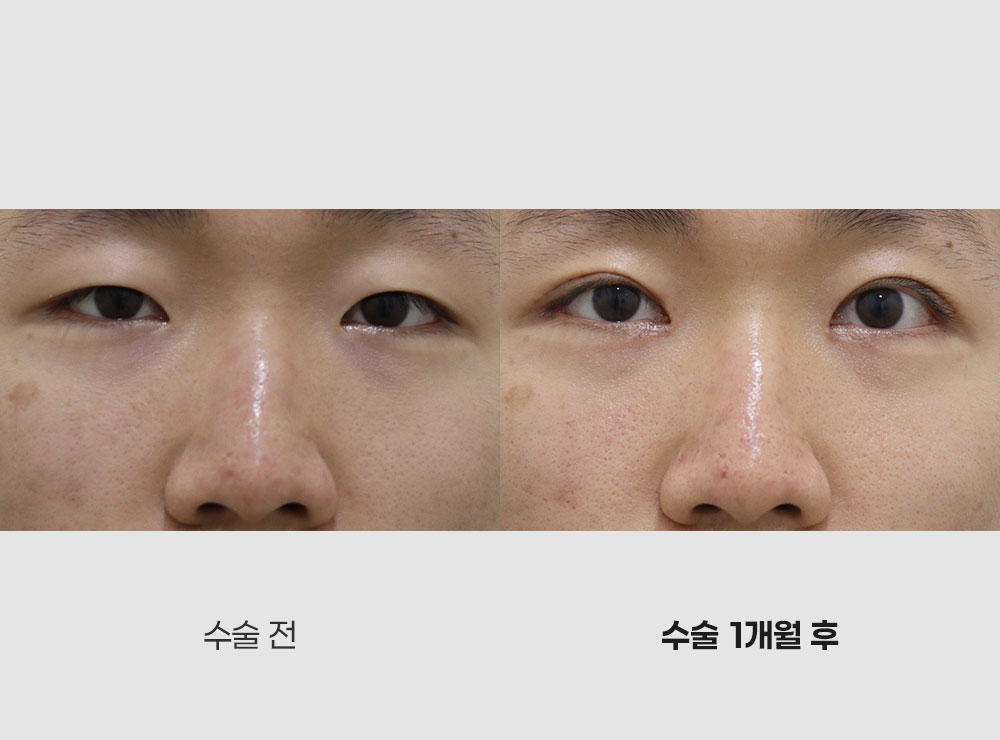 눈매교정트임성형전후사진