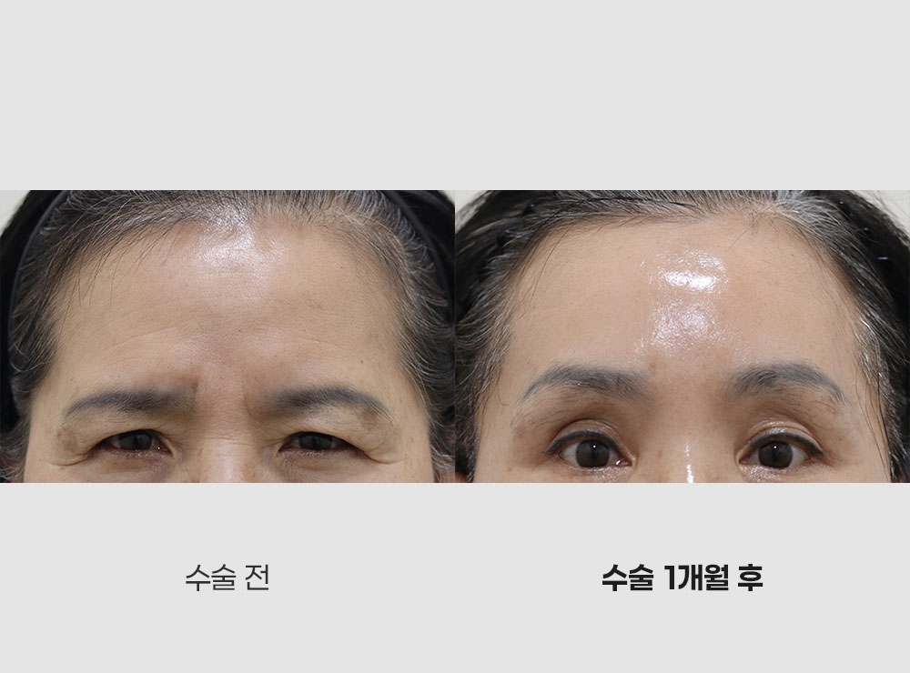 이마거상전후사진