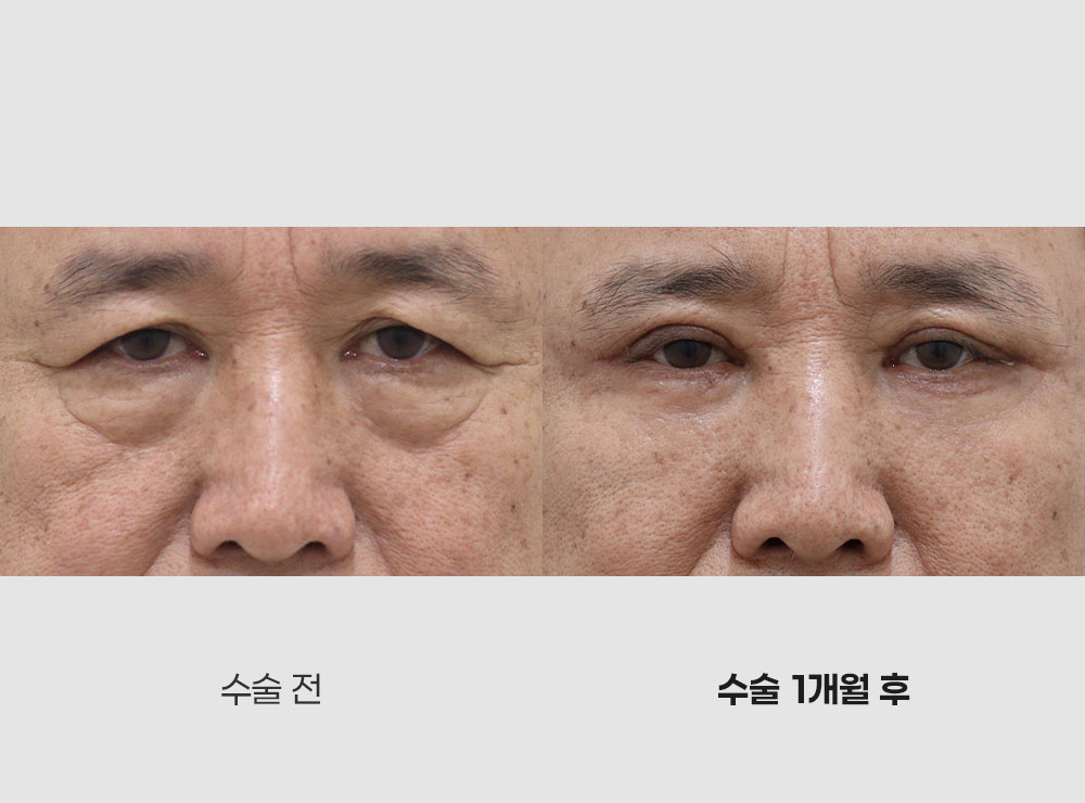 중안면거상전후사진3