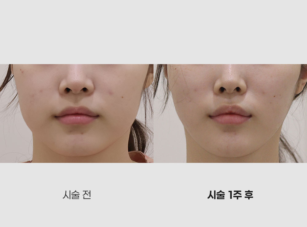 실리프팅전후사진