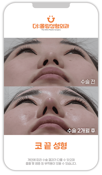 코끝성형전후영상