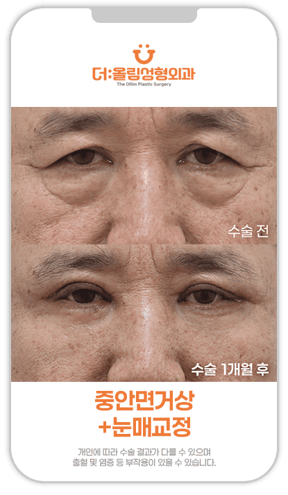 쌍꺼풀수술중안면거상전후영상