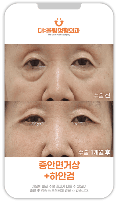 중안면거상전후영상1