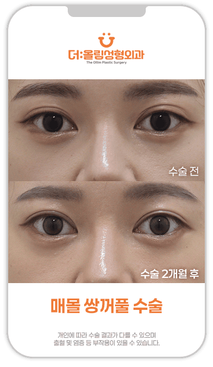 매몰쌍꺼풀수술전후영상