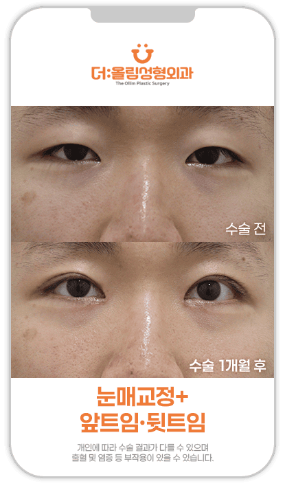 눈매교정트임성형전후영상
