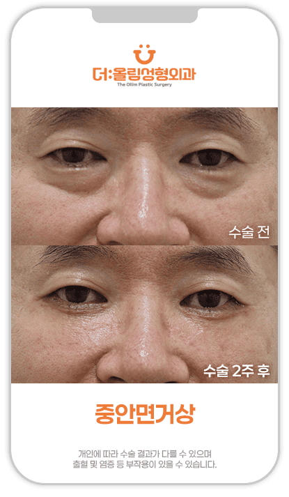 중안면거상전후영상2