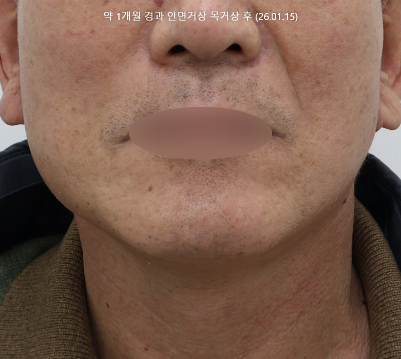 더올림성형외과 하안검수술 후사진 10개월경과