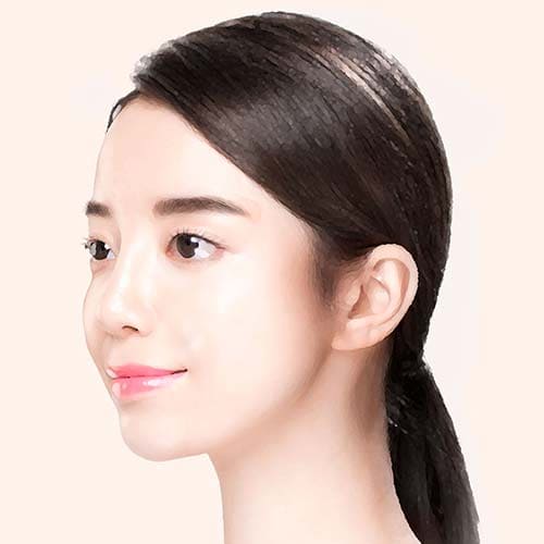안면거상수술방법4리프팅