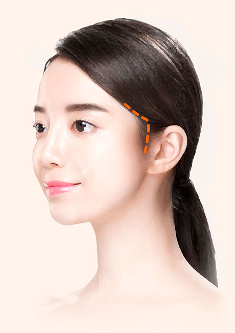 안면거상절개방법L절개법