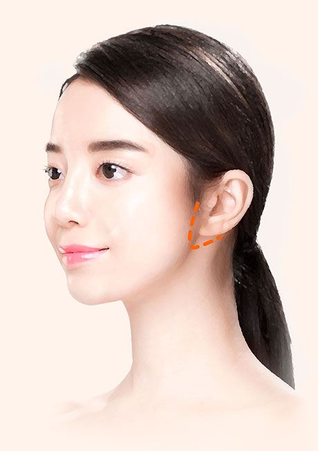 안면거상절개방법V절개법