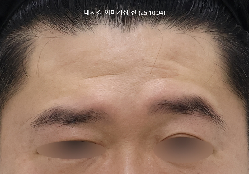 더올림성형외과 하안검수술 전사진