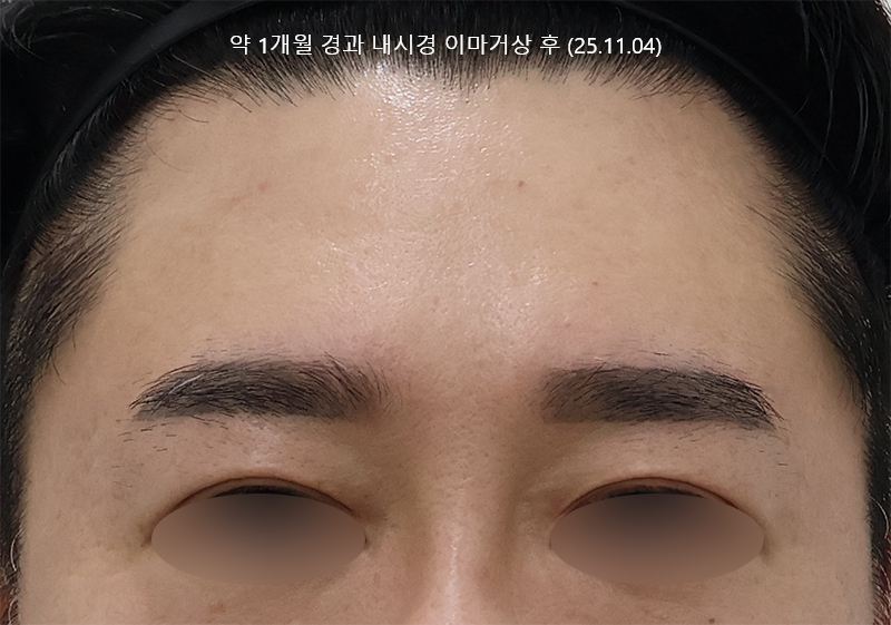 더올림성형외과 하안검수술 후사진 10개월경과