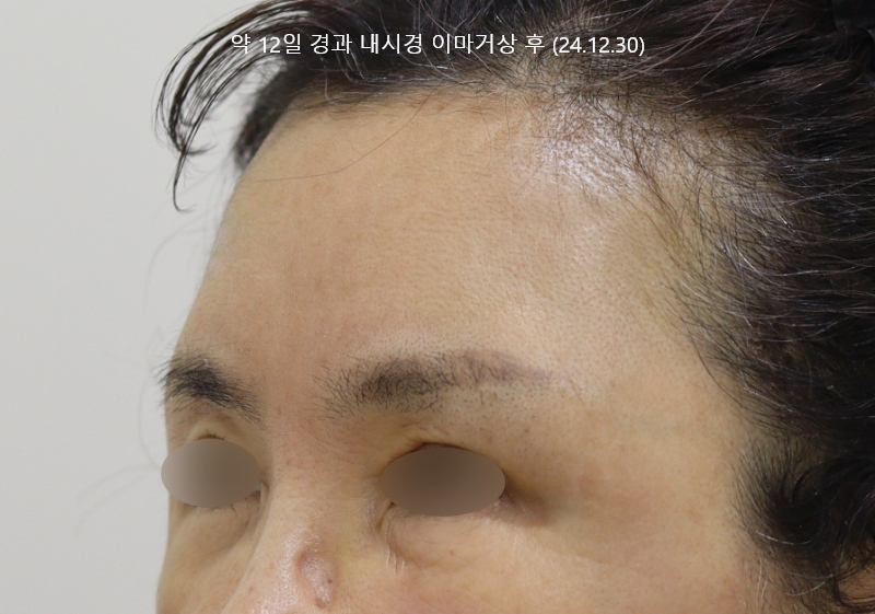 더올림성형외과 하안검수술 후사진 3개월경과