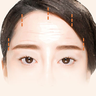 이마거상수술방법1디자인