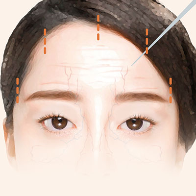 이마거상수술방법2박리