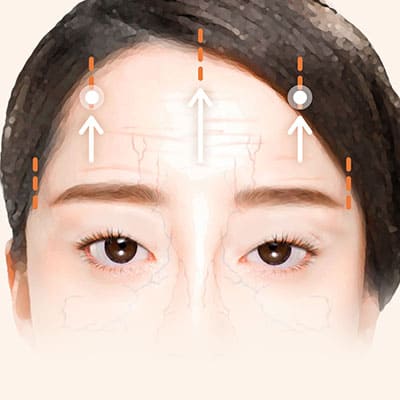 이마거상수술방법3당김