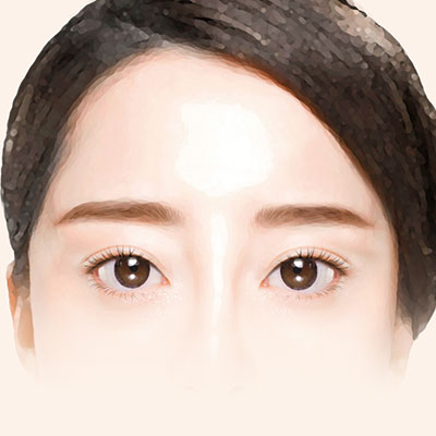 이마거상수술방법4봉합