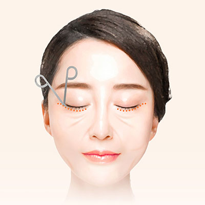 중안면거상수술방법2박시