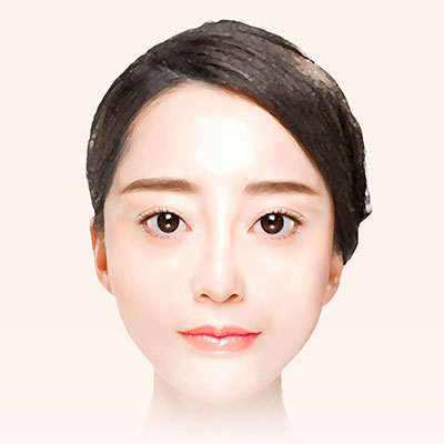 중안면거상수술방법4봉합