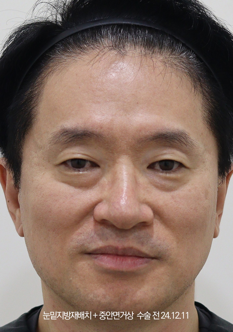 더올림성형외과 중안면거상 수술 전사진