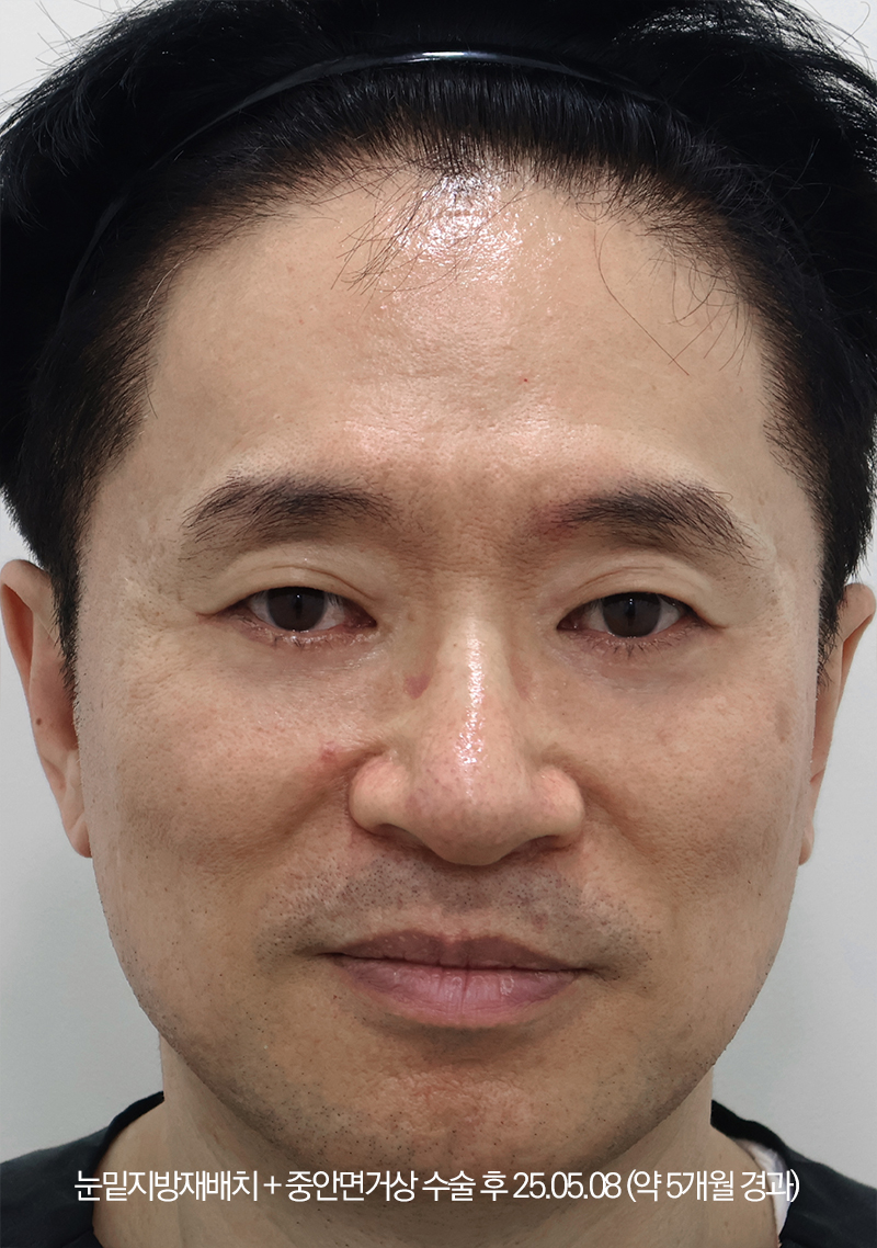 더올림성형외과 중안면거상 수술 후사진 5달경과