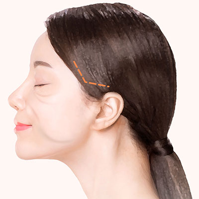 미니거상수술방법1디자인