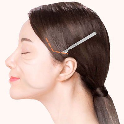 미니거상수술방법2절개