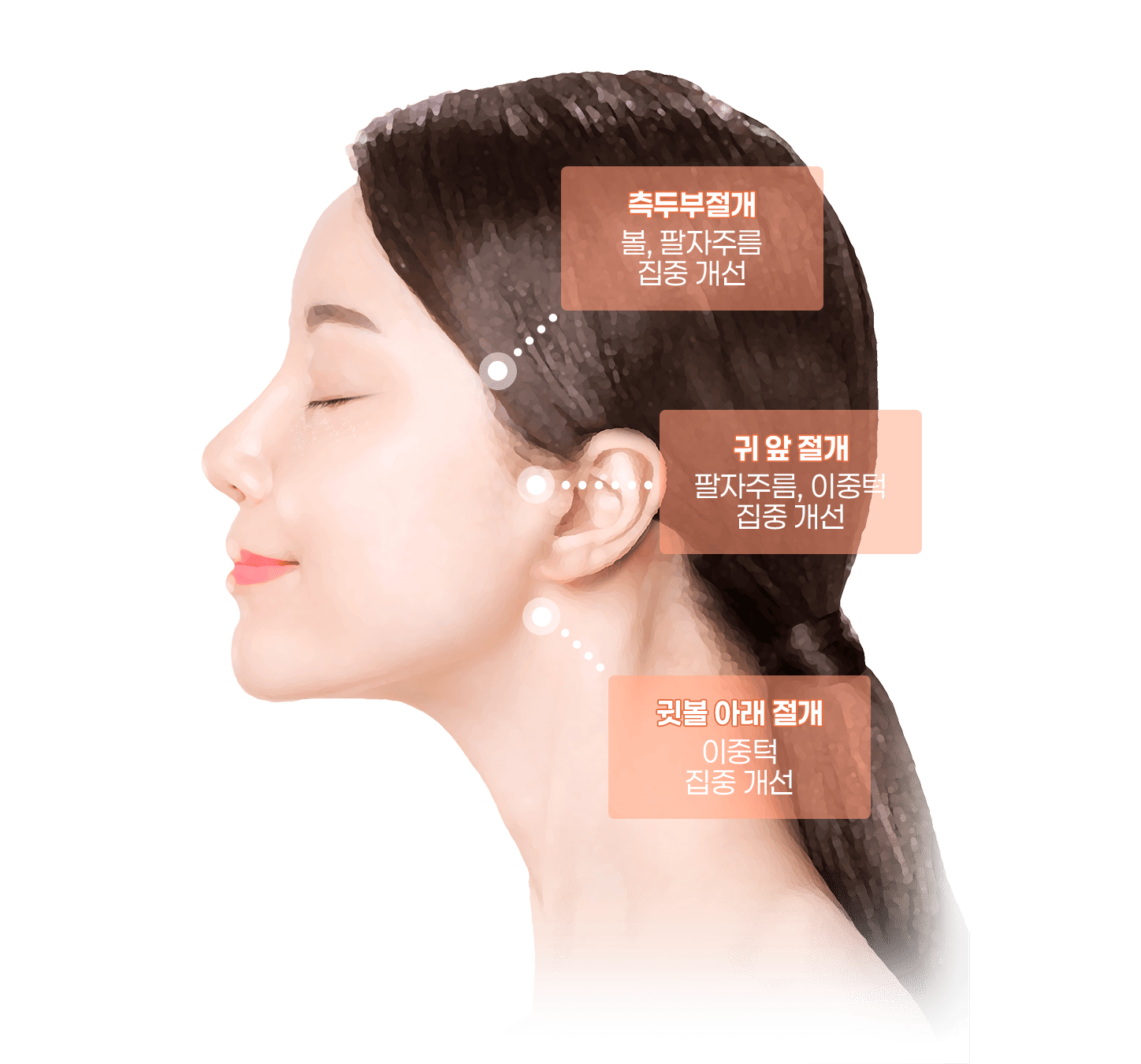 미니거상절개부위