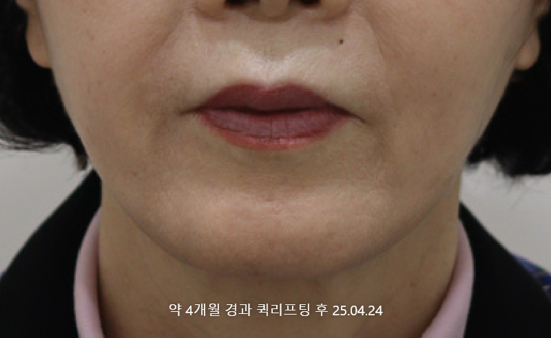 더올림성형외과 퀵리프팅 후사진 4개월경과