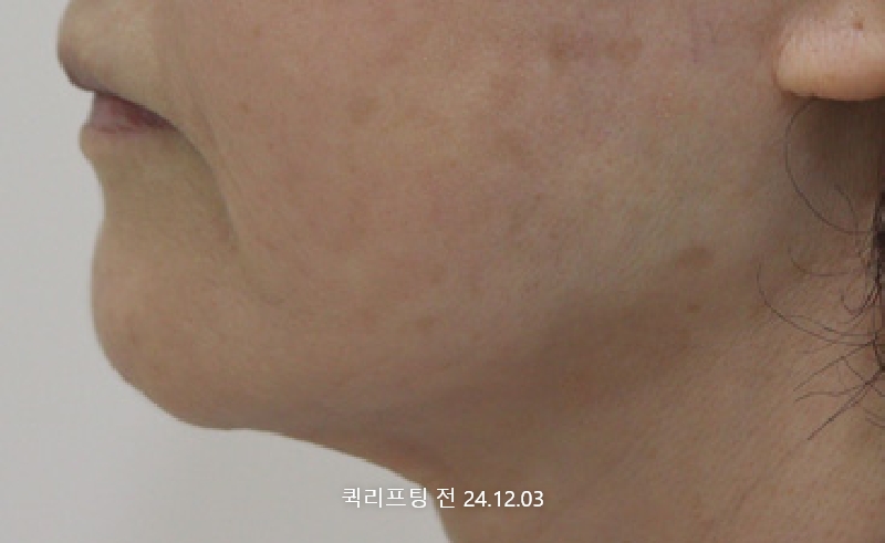 더올림성형외과 퀵리프팅 전사진