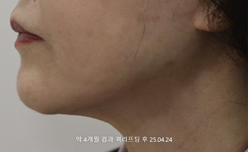 더올림성형외과 퀵리프팅 후사진 4개월경과