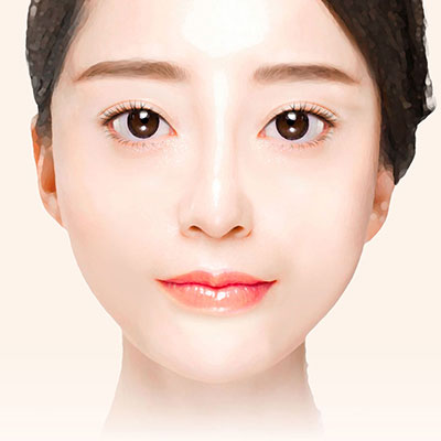 실리프팅단계4마무리