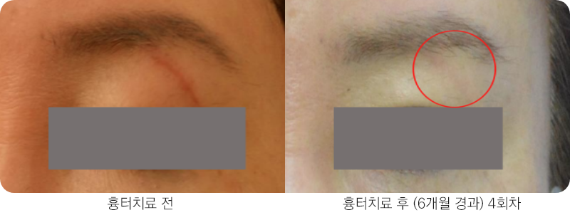 앙코르레이저 찰과성 6개월경과