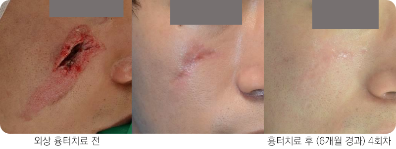 앙코르레이저 외상흉터 6개월경과