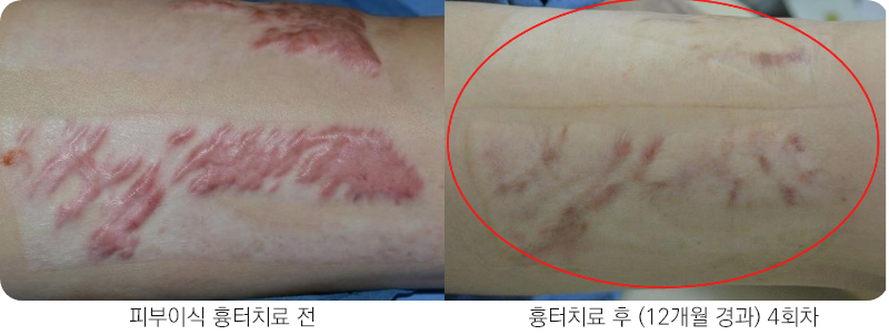 앙코르레이저 피부이식흉터 6개월경과