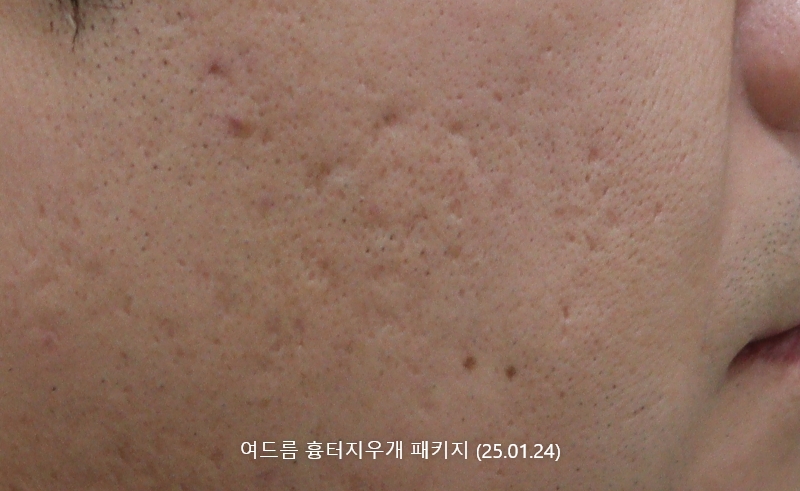 앙코르레이저 여드름흉터 4개월경과