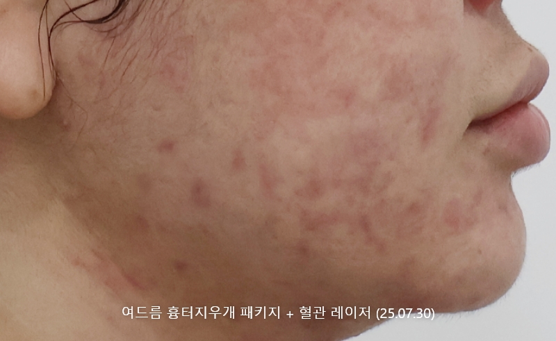 앙코르레이저 여드름흉터 1개월경과