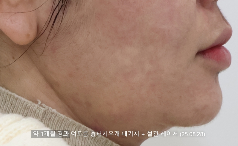 앙코르레이저 여드름흉터 1개월경과