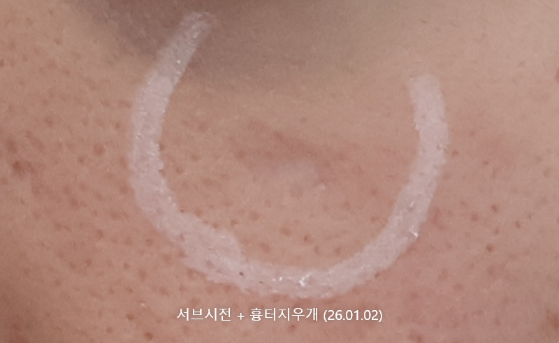 앙코르레이저 여드름흉터 3주경과