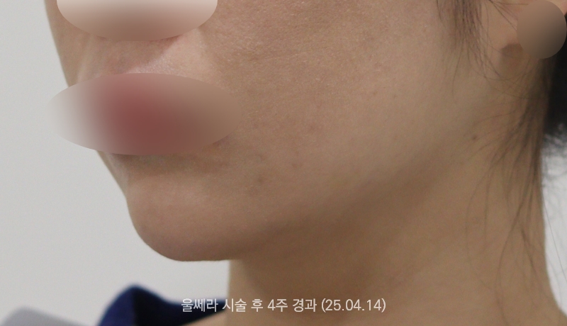 더올림성형외과 울쎄라 후사진 1개월경과