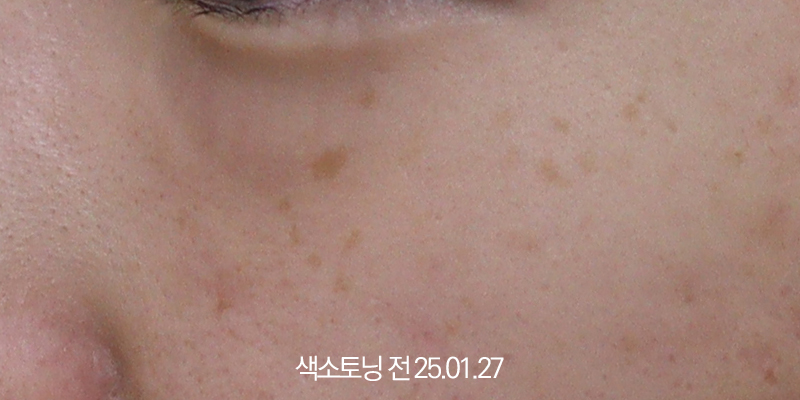 더올림성형외과 토닝 전사진