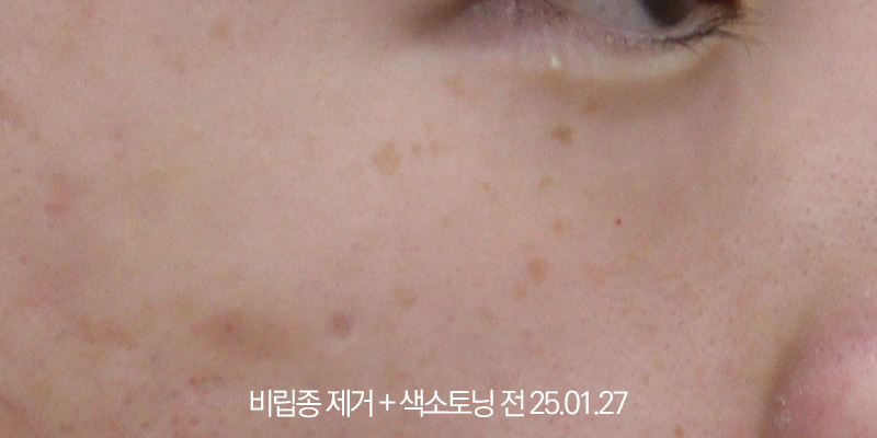 더올림성형외과 비립종제거+토닝 전사진