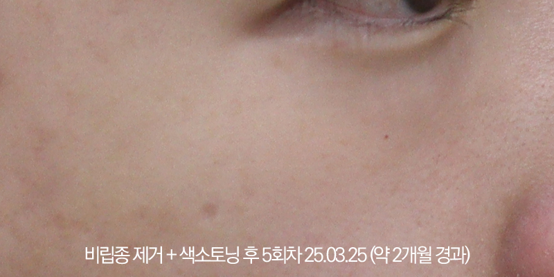 더올림성형외과 비립종제거+토닝 후사진 2개월경과
