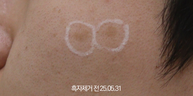 더올림성형외과 흑자제거 전사진