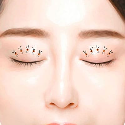 눈매교정비절개수술1연결