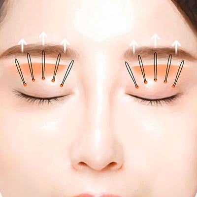 눈매교정비절개수술2조절